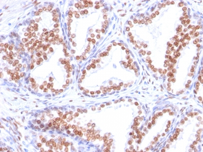 FFPE human prosate adenocarcinoma sections stained with 100 ul anti-Androgen Receptor (clone DHTR/882) at 1:200. HIER epitope retrieval prior to staining was performed in 10mM Tris 1mM EDTA, pH 9.0.